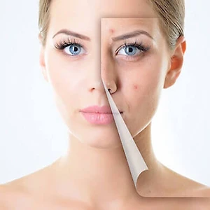 100 suất điều trị mụn cao cấp phương pháp độc quyền tại Nitipon Clinic