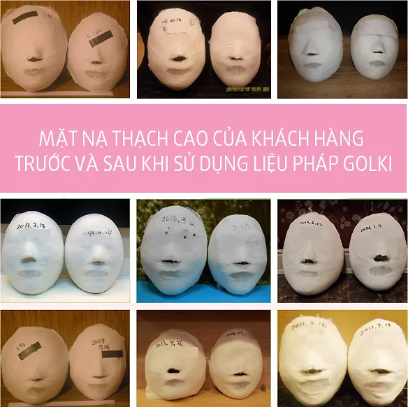 Mặt nạ thạch cao của khách hàng sau khi dùng phương pháp Golki