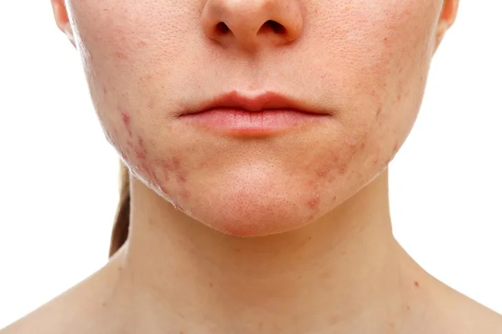 cách trị mụn 09 cách trị mụn 09