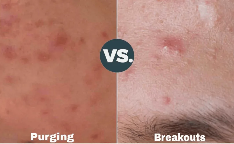 Purging và breakout: Khái niệm đẩy mụn rất hay bị nhầm lẫn