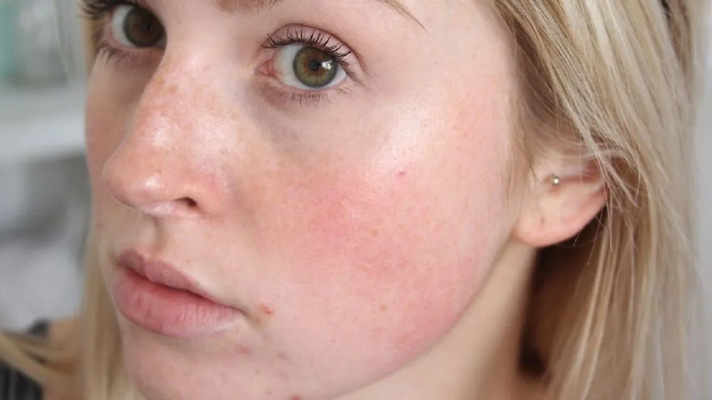 Công dụng của Niacinamide - Thành phần nên có trong quy trình chăm sóc da