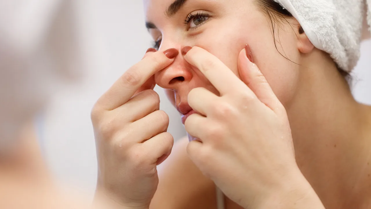 nặn mụn bằng tay ở mũi, vết thâm mụn
