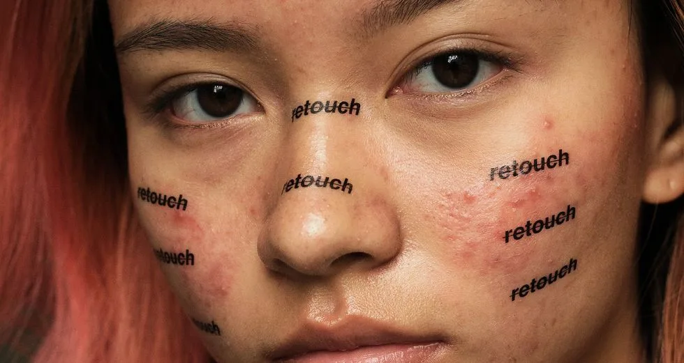 Kem trị mụn nào tốt: Benzoyl peroxide hay Salicylic acid? Kem trị mụn nào tốt: Benzoyl peroxide hay Salicylic acid?