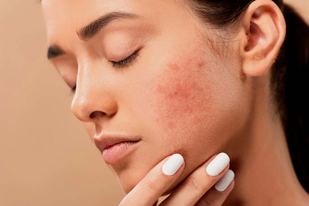 Đi tìm lời đáp: Retinol hoạt động thế nào trên da mụn và có thực sự hiệu quả? Đi tìm lời đáp: Retinol hoạt động thế nào trên da mụn và có thực sự hiệu quả?
