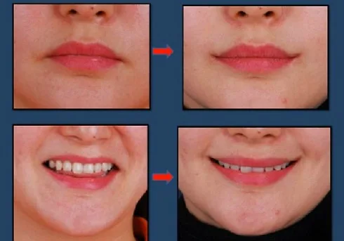 Môi cười mang đến vẻ ngoài tươi tắn rạng rỡ cho bạn gái