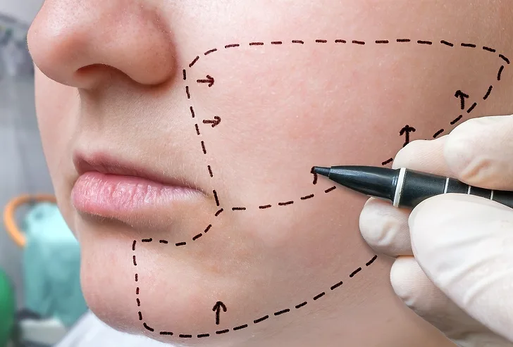 bí quyết đẹp mặt nọng phẫu thuật 1 bí quyết đẹp mặt nọng phẫu thuật 1