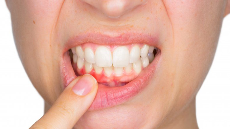 Những hiểm hoạ ít người biết về việc đánh răng không thường xuyên