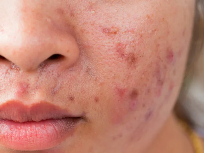Bức tranh toàn cảnh về làn da khi bạn quá lạm dụng treatment: AHA, BHA Bức tranh toàn cảnh về làn da khi bạn quá lạm dụng treatment: AHA, BHA