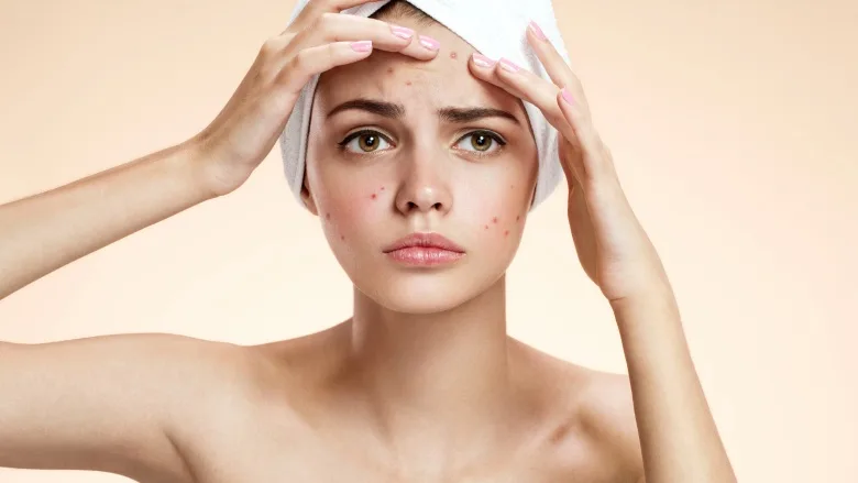 Các đốt mụn đáng ghét được cho là sản sinh ra từ những lớp trang điểm dày trên da mặt