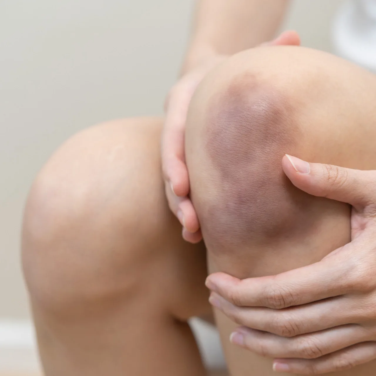 Hình ảnh vết bầm trên đầu gối cô gái.