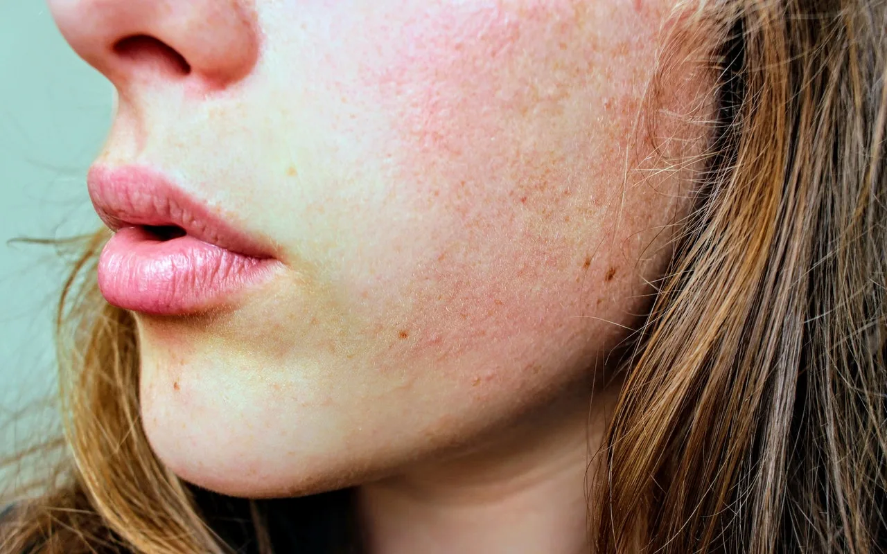 Ngủ khi tóc ướt làm tăng nguy cơ nhiễm nấm trên da đầu