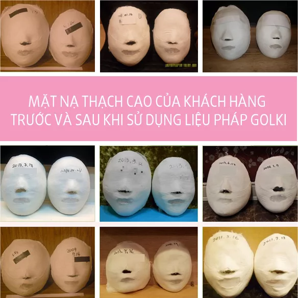 Mặt nạ thạch cao của khách hàng sau khi dùng phương pháp Golki