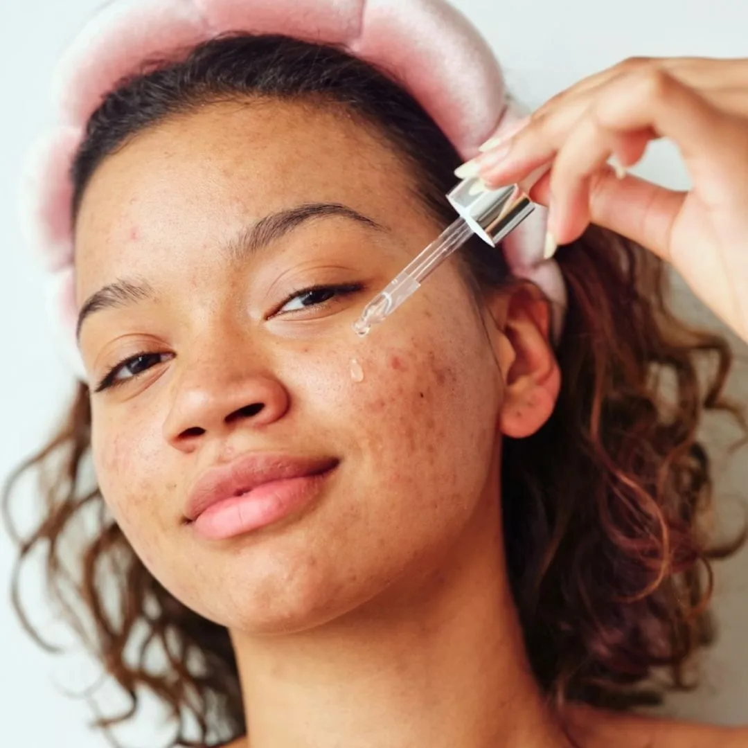 Sử dụng retinoid giúp da cải thiện tình trạng sẹo rỗ