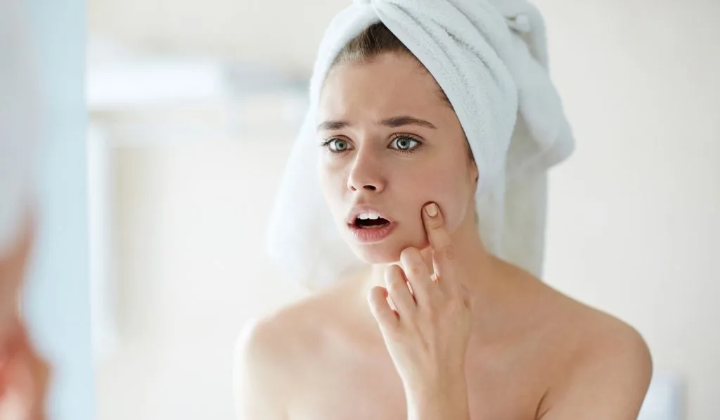 miếng dán trị mụn 4 miếng dán trị mụn 4