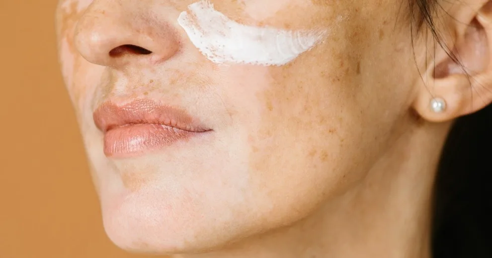 3 hoạt chất không nên dùng trong trị nám để tránh làm tổn thương da & sức khỏe