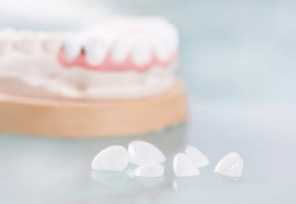 chăm sóc răng miệng - dán sứ veneer