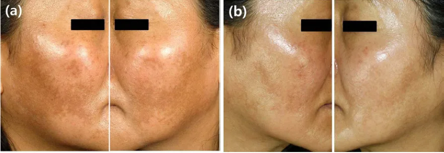 Khám phá công thức tối ưu nhất trong trị nám & làm trắng Khám phá công thức tối ưu nhất trong trị nám & làm trắng