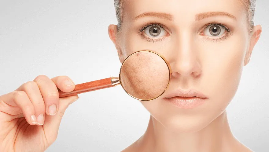 trị thâm mụn 5 trị thâm mụn 5