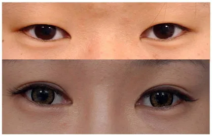 Phương pháp nhấn mí mắt thực hiện khá nhanh chóng và tiêu tốn một khoảng tiền không lớn, phù hợp với các bạn gái ưa chuộng đôi mắt hai mí to tròn