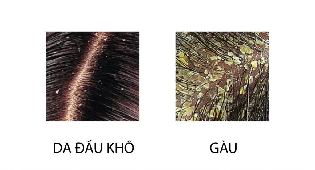 Phân biệt da đầu khô và gàu 2 Phân biệt da đầu khô và gàu 2