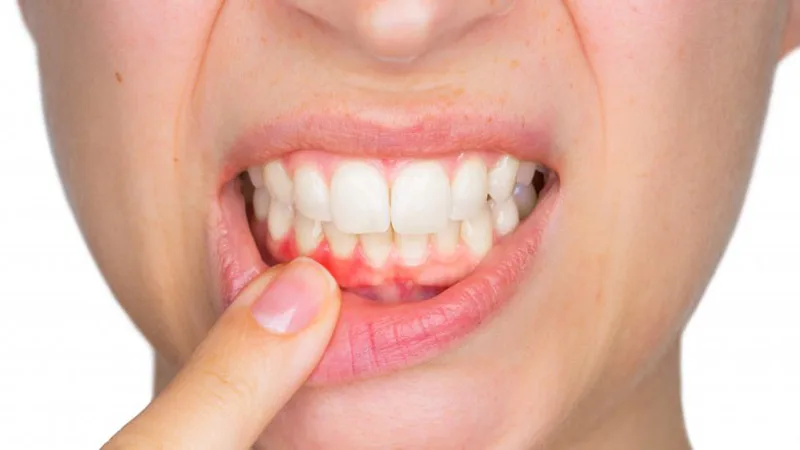 Những hiểm hoạ ít người biết về việc đánh răng không thường xuyên