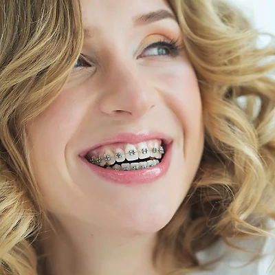 Nhật ký niềng răng: Cần chuẩn bị những gì trước khi chỉnh nha thẩm mỹ? (Phần 2)
