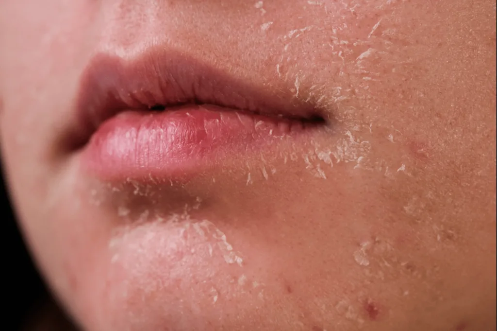 Bức tranh toàn cảnh về làn da khi bạn quá lạm dụng treatment: AHA, BHA Bức tranh toàn cảnh về làn da khi bạn quá lạm dụng treatment: AHA, BHA
