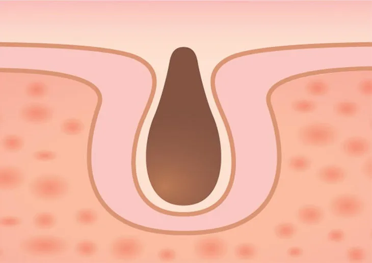 cách trị mụn 03 cách trị mụn 03