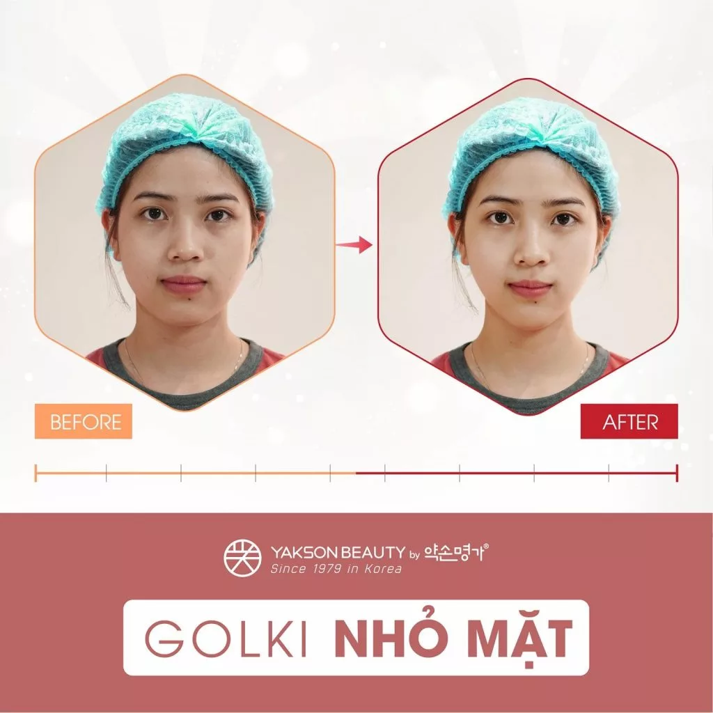 Hiệu quả làm nhỏ mặt từ phương pháp Golki Hiệu quả làm nhỏ mặt từ phương pháp Golki