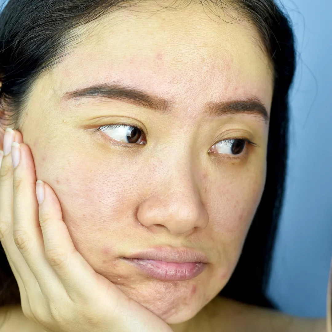 Hình ảnh làn da xỉn màu vì thiếu vitamin C.