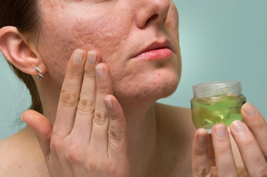 Purging và breakout: Khái niệm đẩy mụn rất hay bị nhầm lẫn