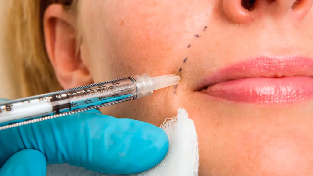 tiêm filler môi rãnh cười hoại tử tia uv