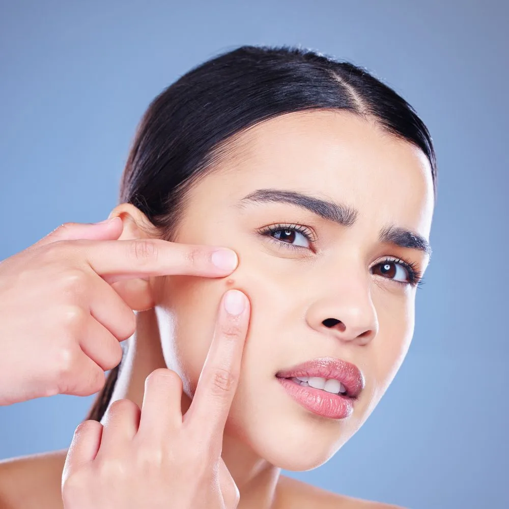 Hình ảnh cô gái nặn mụn, một thói quen xấu đối với làn da dầu mụn.