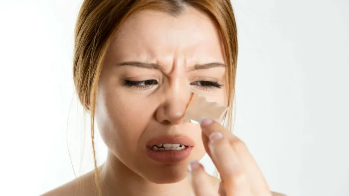 Trị mụn đầu đen ở mũi, chuyện nhỏ! Trị mụn đầu đen ở mũi, chuyện nhỏ!