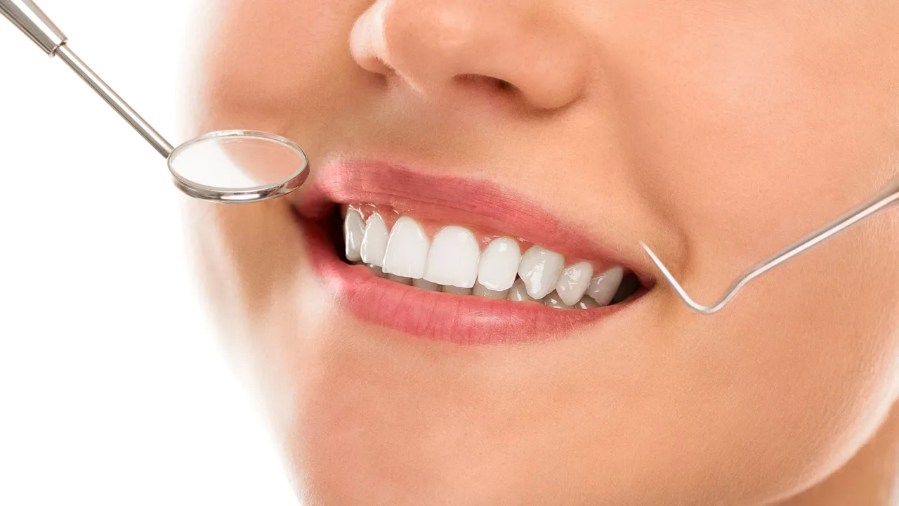 Răng sứ kim loại truyền thống