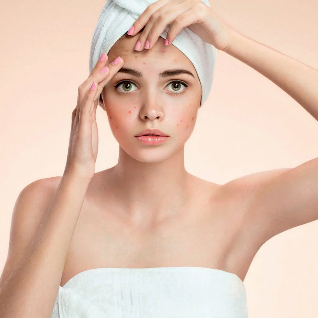 trị mụn đúng cách trị mụn đúng cách