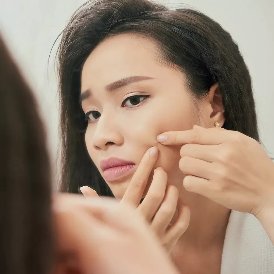 nặn mụn