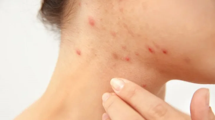cách trị mụn 01 cách trị mụn 01