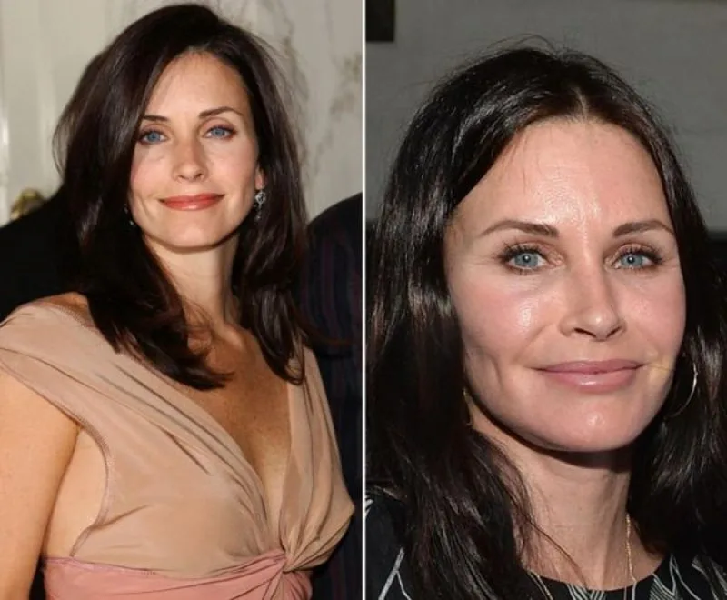 Courtene Cox và khuôn mặt cứng đờ sau khi tiêm botox