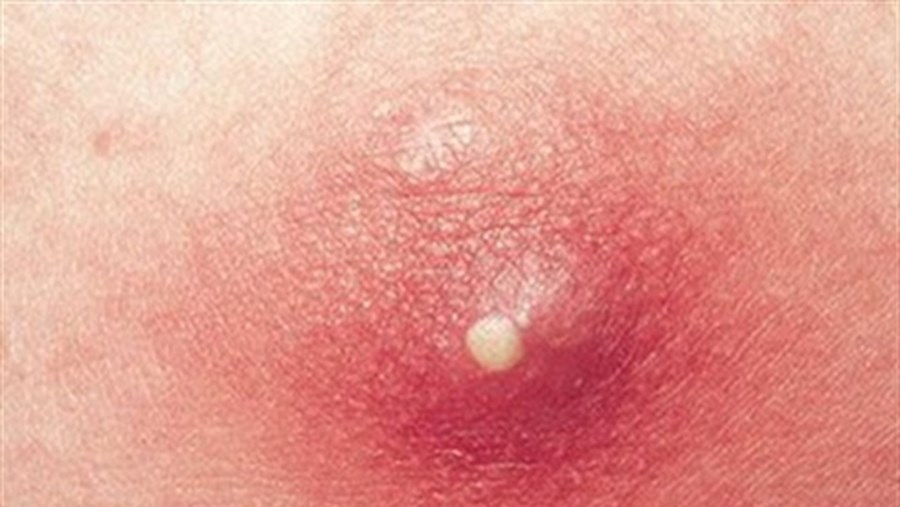 Cách phòng tránh và điều trị mụn vùng kín 3 Cách phòng tránh và điều trị mụn vùng kín 3