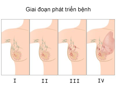 Hình ảnh minh họa từng giai đoạn phát triên của ung thư vú