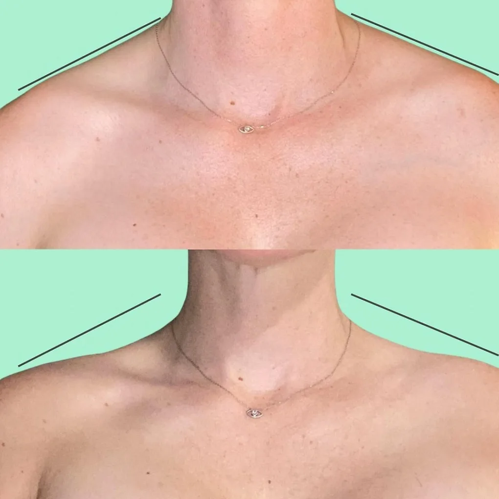 Trào lưu làm đẹp trên tiktok. Barbie Botox: Lăng kính không phải màu hồng của trào lưu chiếc “vai mắc áo”