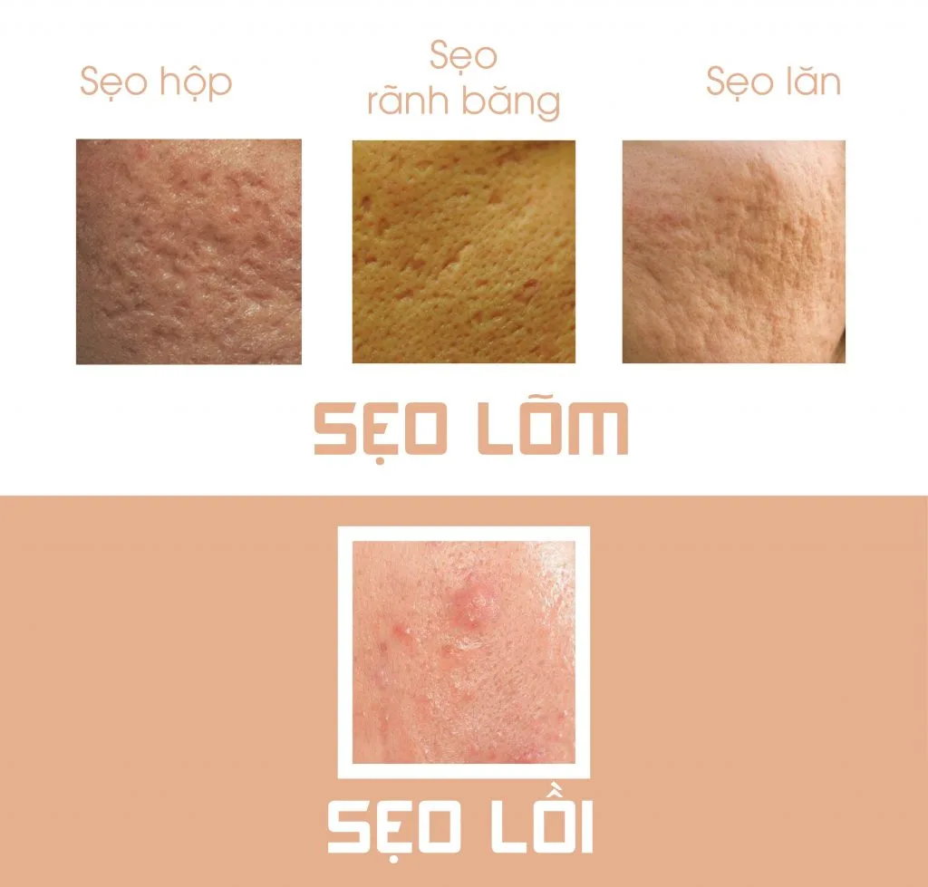 Trị sẹo mụn Trị sẹo mụn