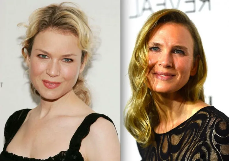 Sự thay đổi trên khuôn mặt của Renee Zellweger khiến nhiều người tự hỏi không biết là hậu quả của việc giảm cân hay tiêm botox