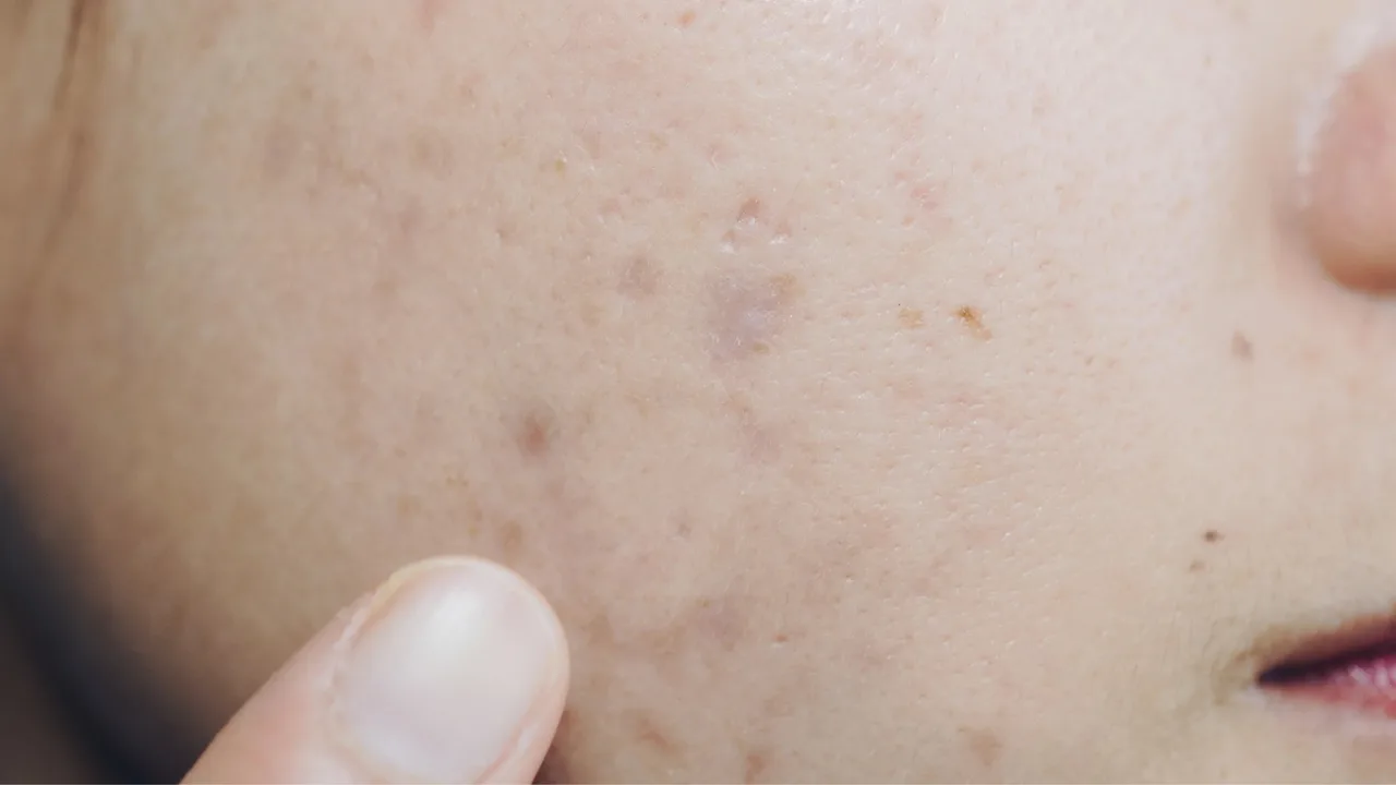 sẹo mụn tăng sắc tố
