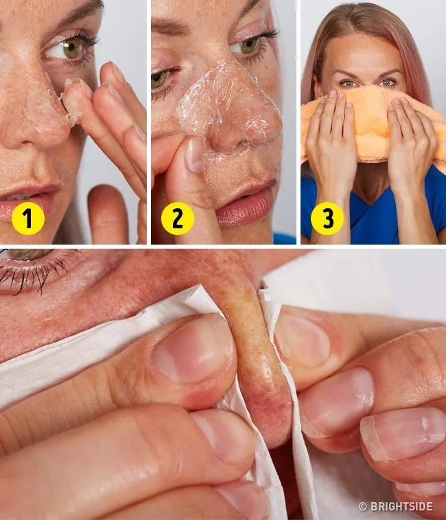trị mụn cám trị mụn cám