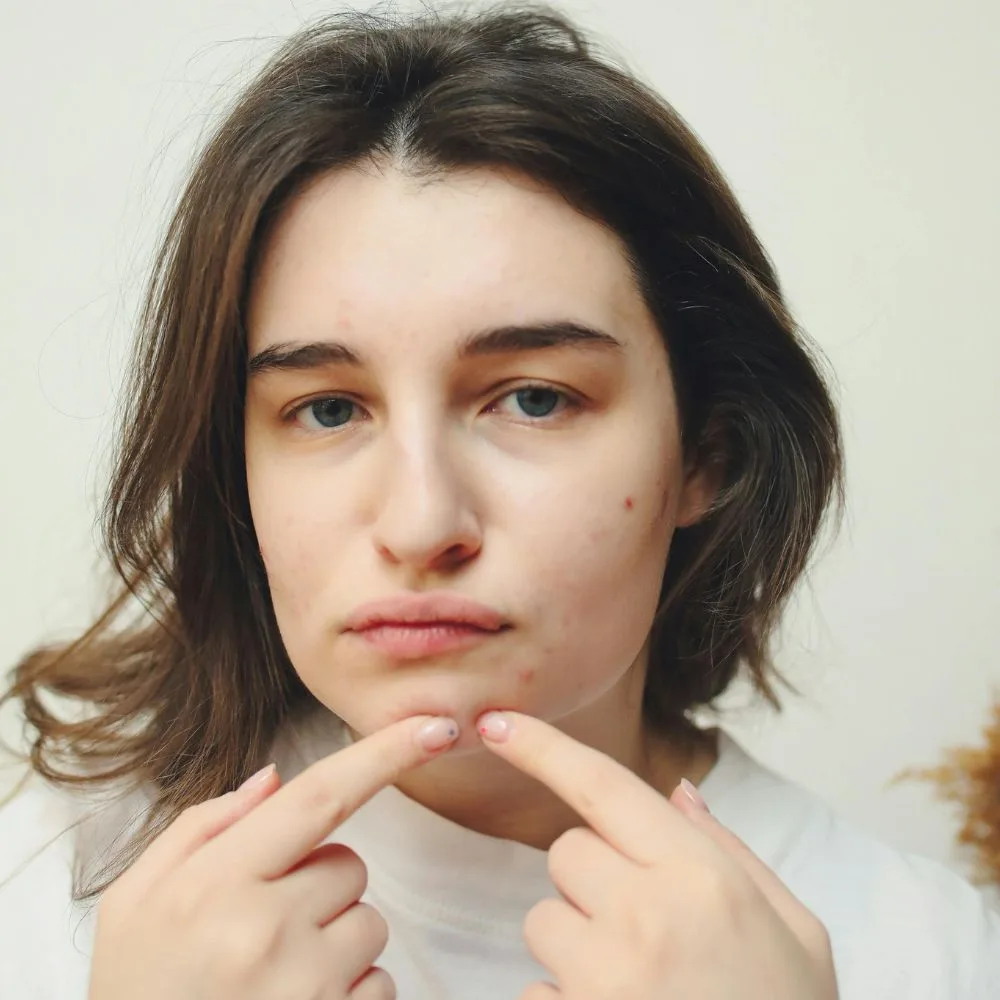cô gái bị nổi mụn