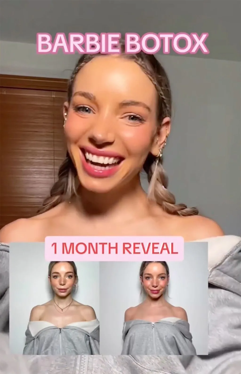 Isabelle Lux và traptox Barbie Botox: Lăng kính không phải màu hồng của trào lưu chiếc “vai mắc áo”