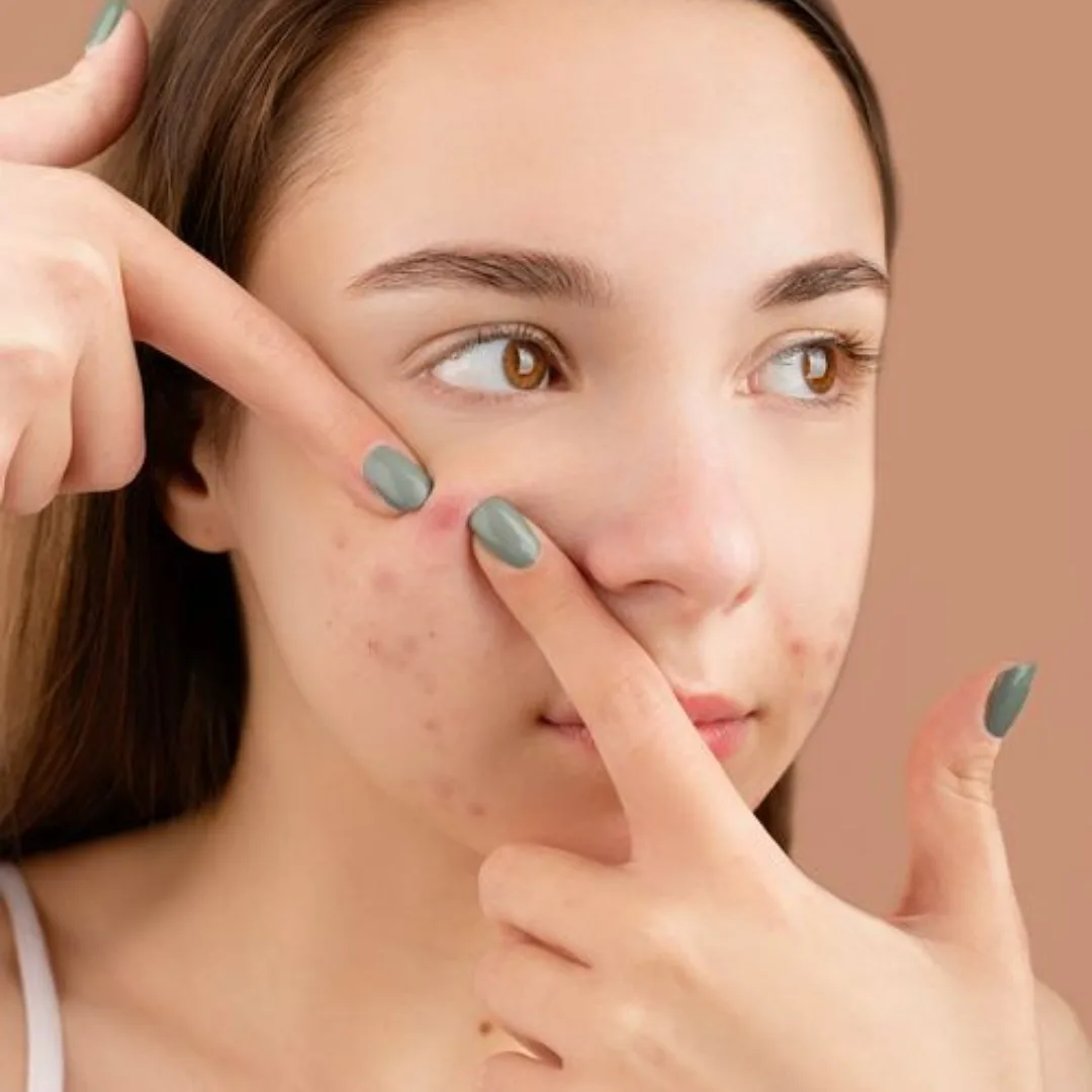 Nặn mụn ngay sau khi rửa mặt