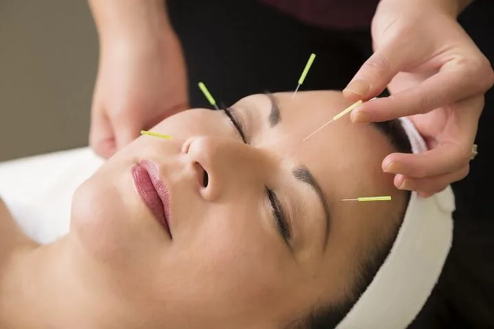 châm cứu da mặt 2 châm cứu da mặt 2